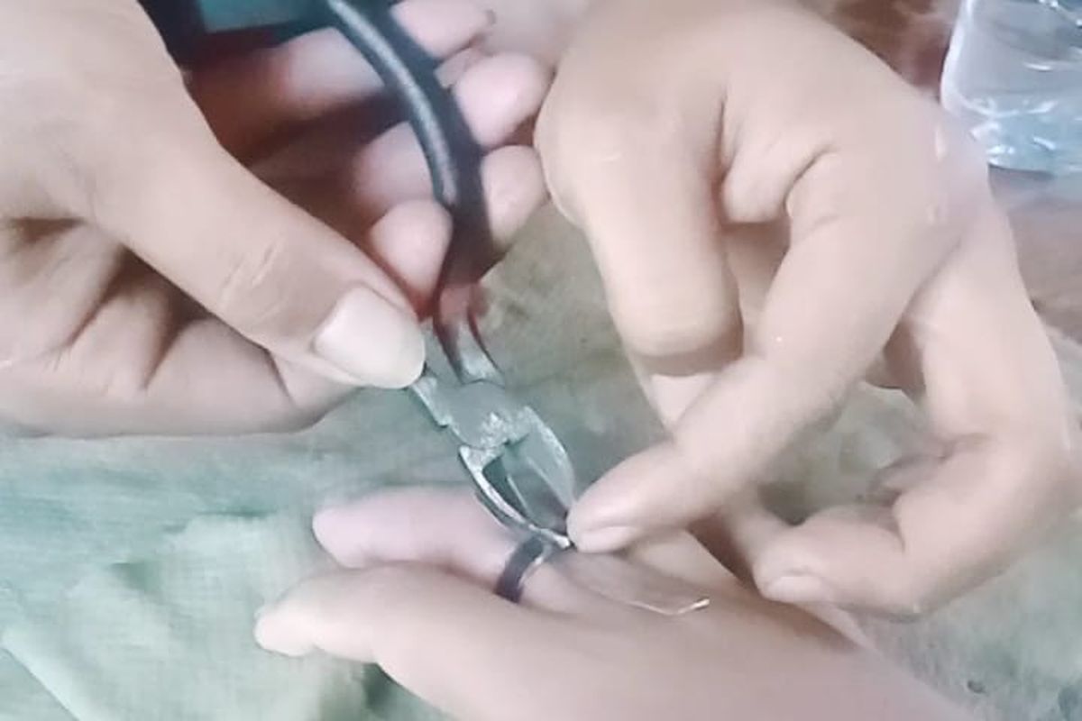 Tangan bocah di Situbondo Jawa Timur bengkak akibat cincin kekecilan.