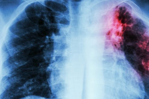 Mirip Difteri, Mengapa Penyebaran TBC Sulit Dikendalikan?