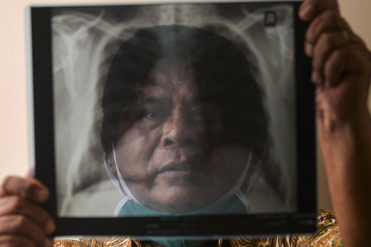 Alben Sitohang (68) menunjukkan hasil rontgen paru-paru miliknya di Jakarta. Wiraswasta itu menjalani isolasi di RS darurat Wisma Atlet selama 22 hari dan dinyatakan negatif pada 19 April 2020.