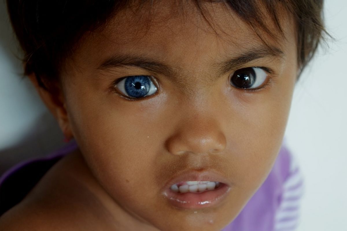 Ditra (3) bocah di Desa Boneatiro, Kecamatan Kapuntori, Kabupaten Buton, Sulawesi Tenggara, memiliki mata yang berbeda. Mata sebelah kanannya berwarna biru dan mata sebelah kirinya berwarna hitam  