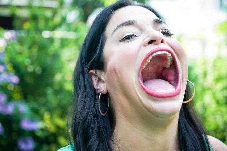 Samantha Ramsdell dengan mulutnya yang besar