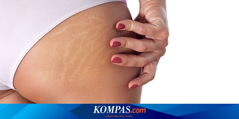 5 Cara Menghilangkan Stretch Mark Putih dengan Efektif