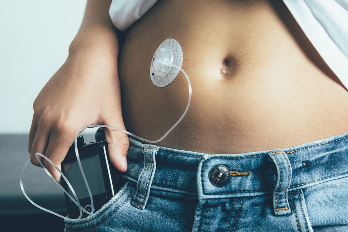 Ilustrasi cara kerja insulin pump.