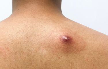 Gejala, Penyebab, dan Cara Mengobati Bisul Halaman all - Kompas.com
