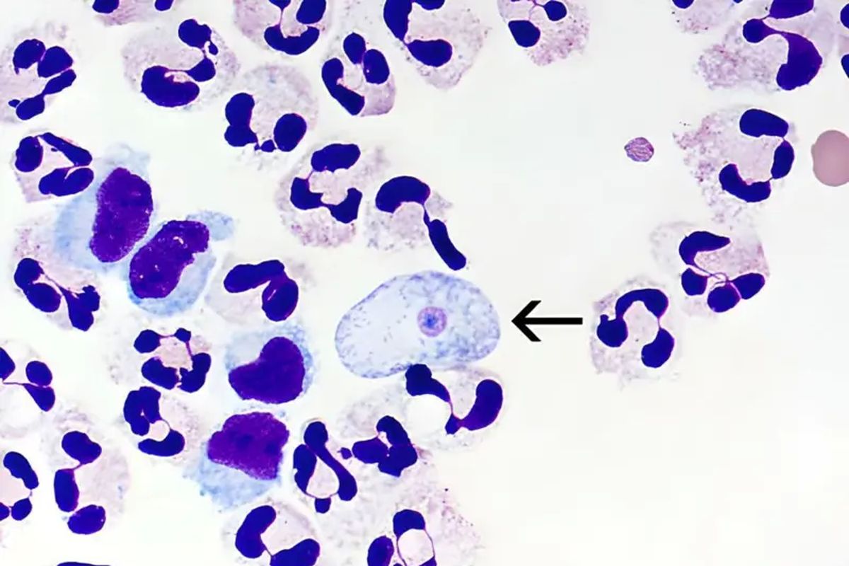 Sitoplasma cairan serebrospinal dengan Naegleria fowleri yang diwarnai (tanda panah). Air yang terlihat jernih dan tenang belum tentu aman. Perubahan iklim membuat amoeba di air tumbuh dan meluas, termasuk amoeba pemakan otak.