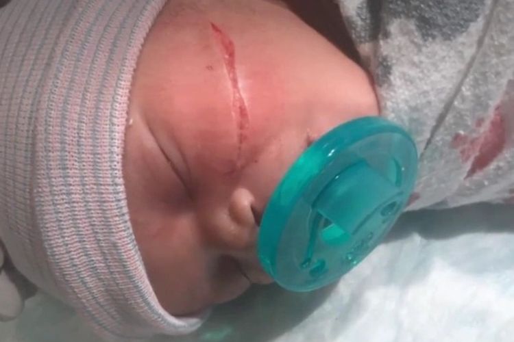 Bayi Kyanni Williams yang menderita luka besar di pipi kirinya setelah dilahirkan dengan operasi caesar. [KRON 4 News Via The Sun]