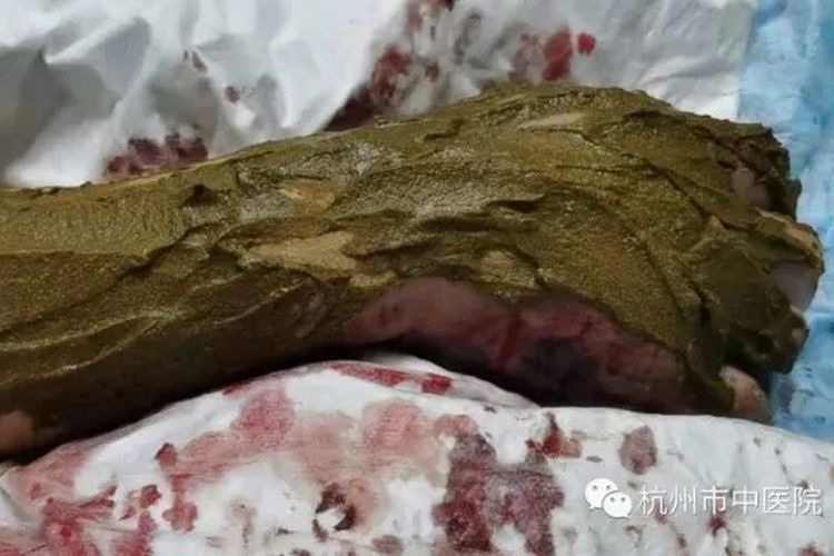Lengan kanan Yu (63) pria asal China timur saat dirawat di Rumah Sakit Tradisional Hangzhou pada Kamis (27/5/2021), akibat digigit ular beludak yang hendak dia jadikan wine.