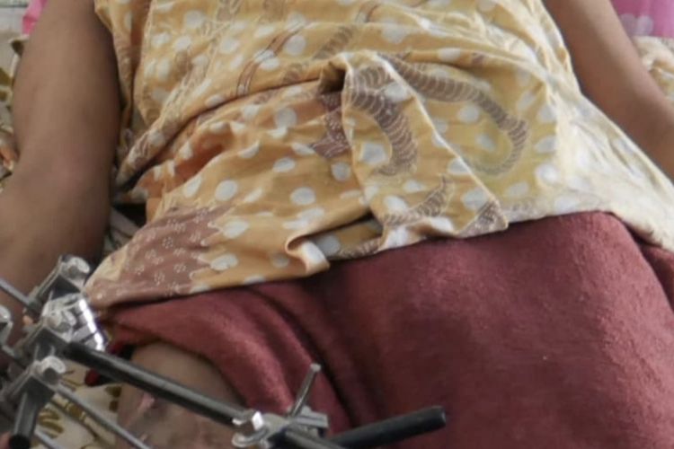 Tak Mampu Berobat, Remaja di Pamekasan 8 Bulan Hidup dengan Kaki Patah