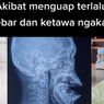 Viral Mulut Tak Bisa Ditutup Akibat Menguap Terlalu Lebar, Ini Penjelasan Dokter