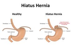 Hernia Hiatus