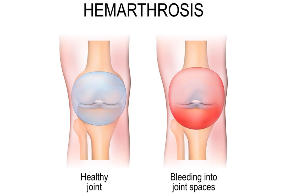 Ilustrasi hemarthrosis