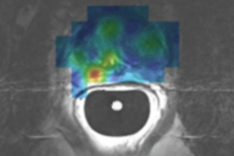 Pemindaian MRI hyper-polarisasi dapat menjadi cara masa depan untuk mendiagnosa kanker prostat. 