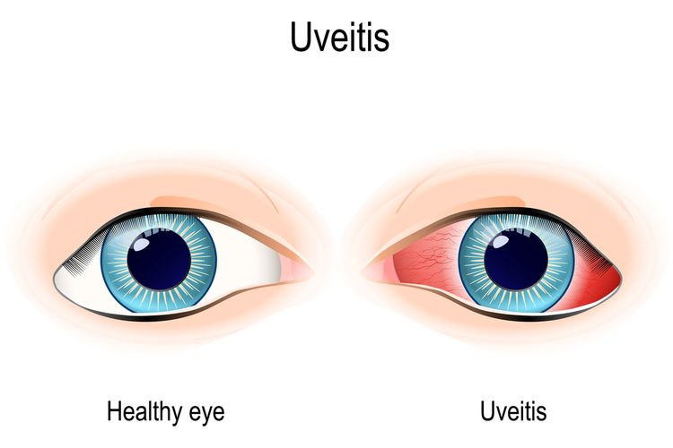 Ilustrasi Uveitis