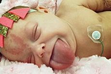 Lidah Selalu Terjulur, Bayi Ini Sempat Sulit Makan dan Senyum