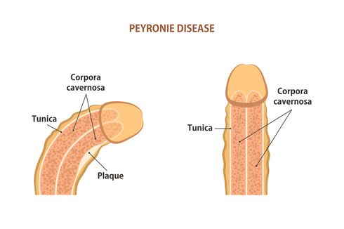 Penyakit Peyronie