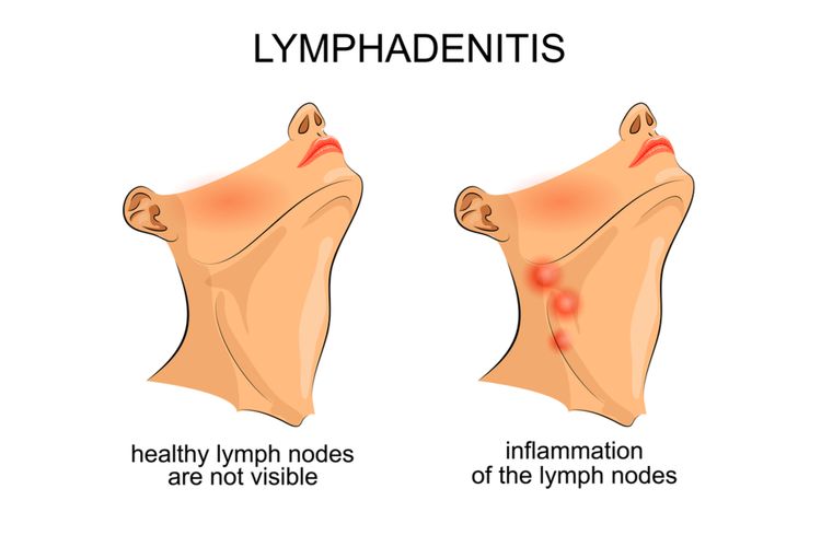 Ilustrasi Limfadenitis