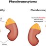 Pheochromocytoma