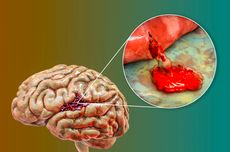 16 Ciri-ciri Pendarahan Otak yang Pantang Diabaikan