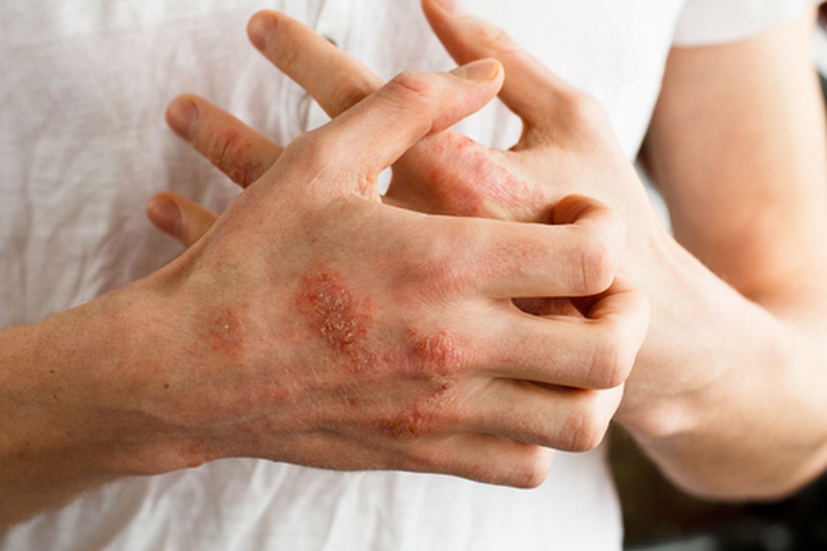 Eksim adalah kondisi yang menyebabkan kulit meradang, iritasi, dan gatal. Apakah eksim bisa menular?