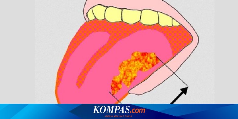 Kanker Lidah Dan Mulut Seperti Apa Wujud Gejala Awalnya