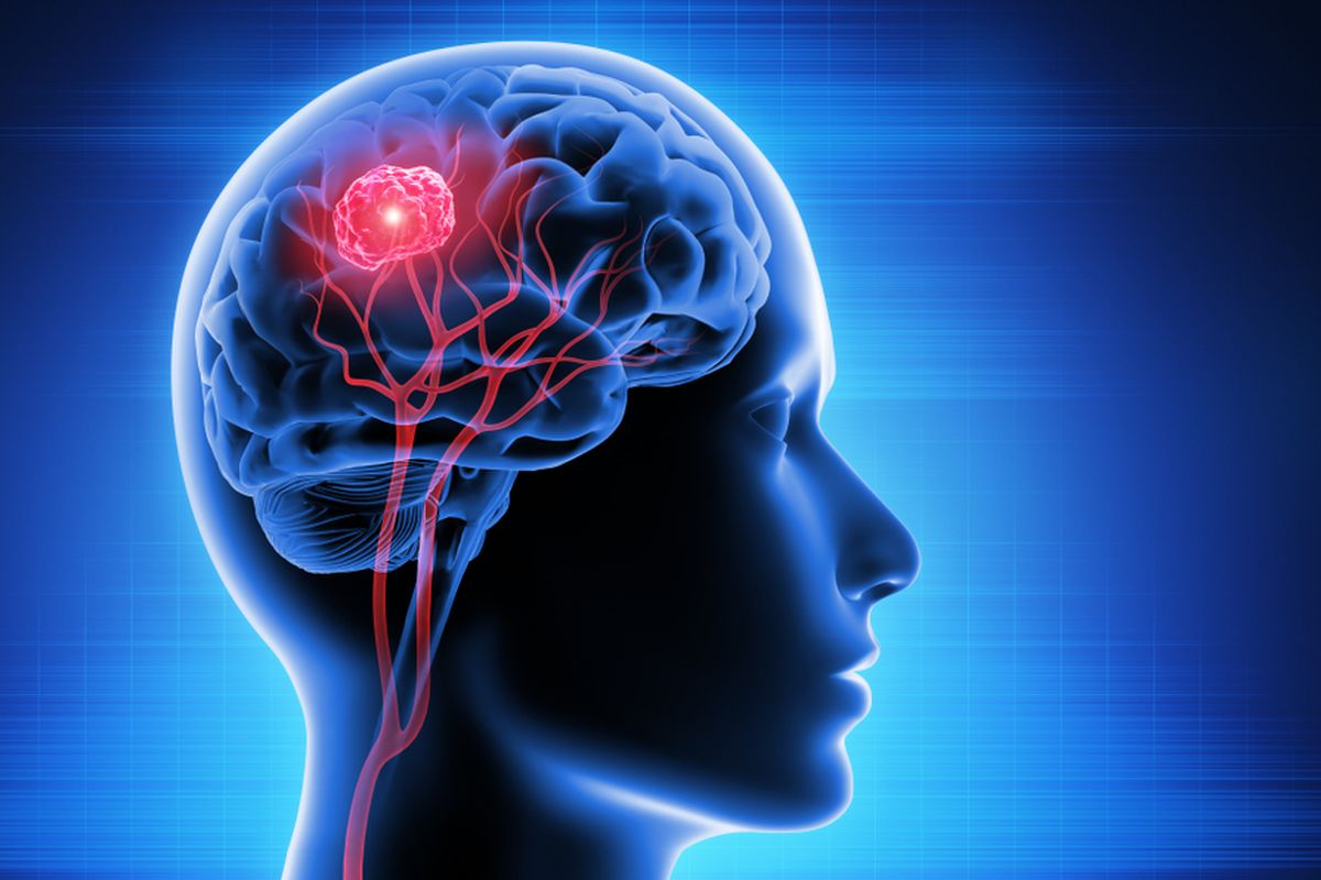 Ilustrasi glioblastoma. Glioblastoma adalah salah satu jenis kanker otak. Ini adalah tumor otak ganas yang paling umum terjadi pada orang dewasa. 