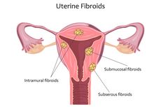 3 Jenis Makanan yang Dapat Mencegah Fibroid Rahim Menurut Dokter