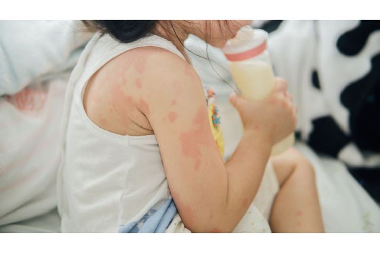 Ilustrasi gejala alergi susu pada anak