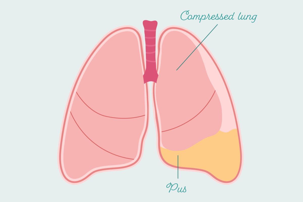 Ilustrasi Epiema