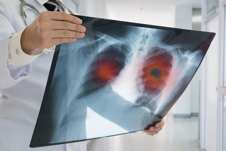 Jenis penyakit paru-paru yang paling umum, meliputi penyakit saluran napas, penyakit jaringan paru-paru, dan penyakit sirkulasi paru-paru.