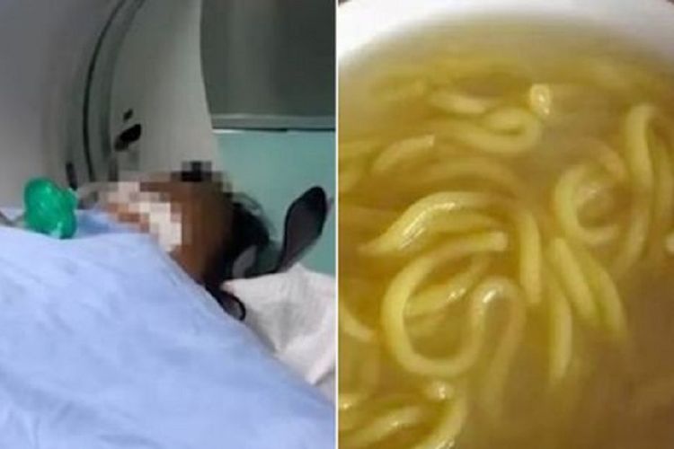 Salah satu korban keracunan akibat memakan mi berusia satu tahun di Heilongjiang, China. Sebanyak 9 anggota keluarga meninggal setelah memakan mi buatan sendiri yang terkontaminasi asam bongkrek.