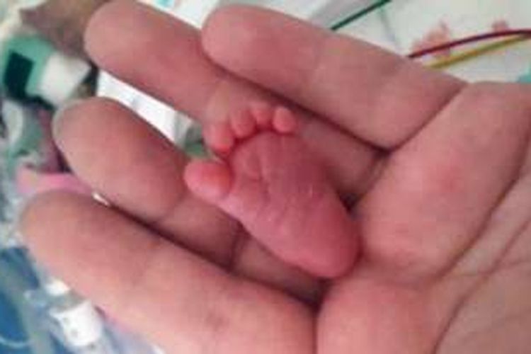 Bayi Emilia yang dilahirkan prematur di usia kehamilan 26 minggu bobotnya hanya 8 ons.