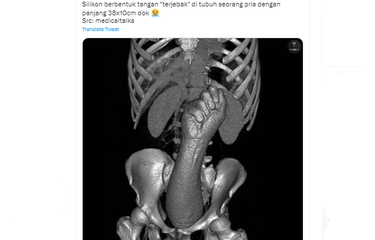Tangkapan layar twit soal tangan silikon terjebak dalam tubuh