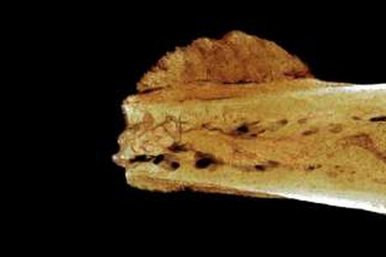 Kanker tertua yang ditemukan pada fosil moyang manusia berusia 1,7 juta tahun.