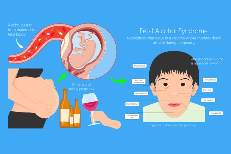 Ilustrasi Fetal Alcohol Syndrome