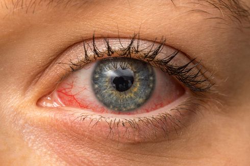 Kenapa Mata Tiba-tiba Merah? Kenali 8 Penyebab dan Cara Mengatasinya