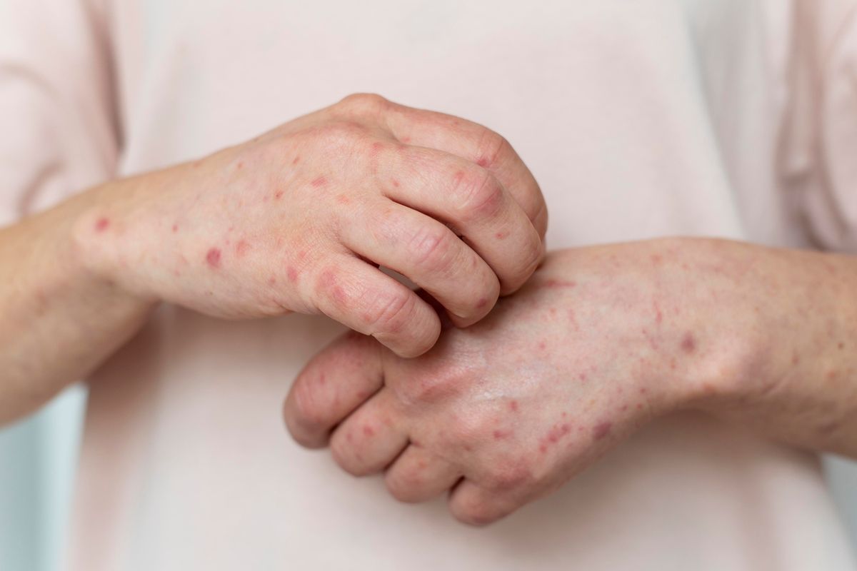 Ilustrasi mpox. WHO kembali menetapkan mpox sebagai darurat kesehatan global setelah lonjakan kasus, menambah kekhawatiran terhadap penyebaran penyakit ini di Indonesia.