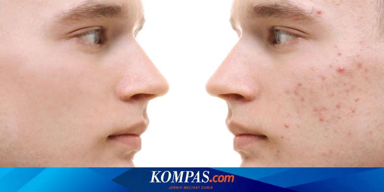 Bosan Dengan Bruntusan Di Pipi Coba 9 Cara Mudah Berikut Halaman All Kompas Com