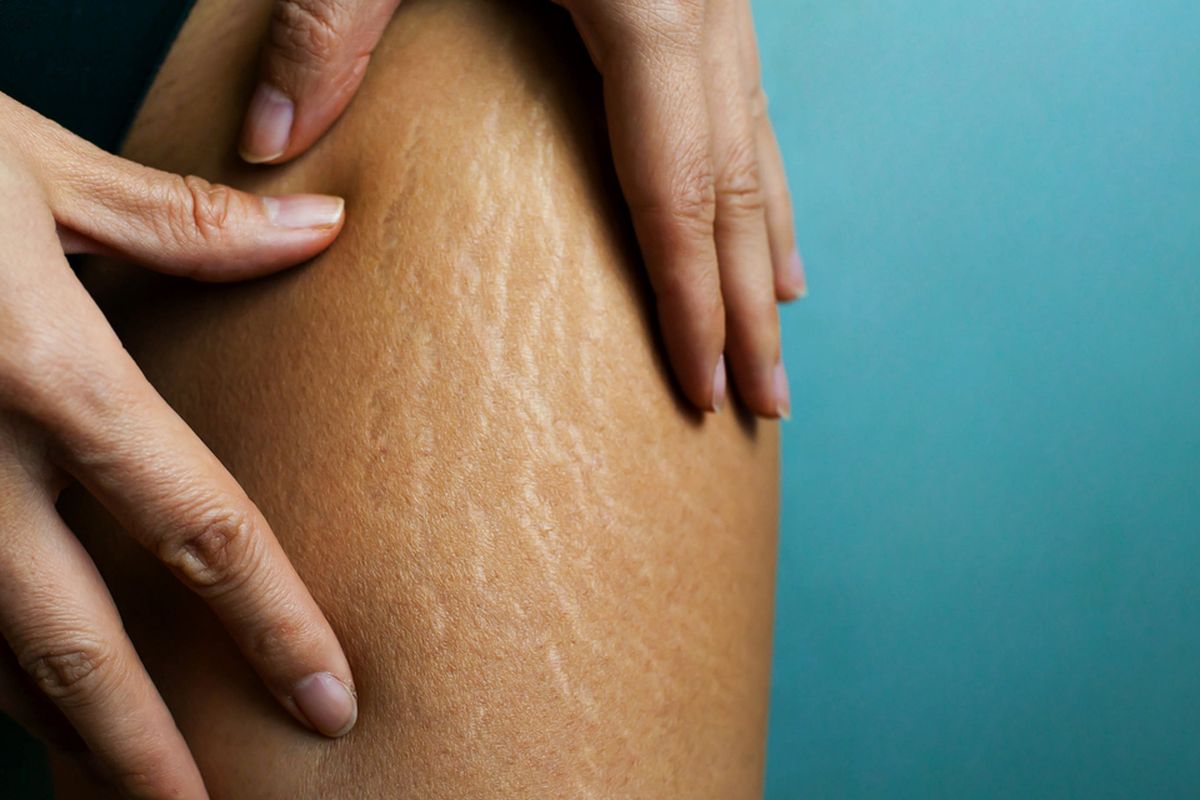 ilustrasi stretch mark