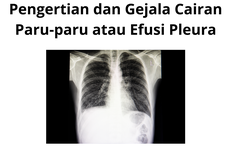 Pengertian dan Gejala Cairan Paru-paru atau Efusi Pleura