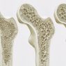 20 Oktober 1996: Hari Osteoporosis Sedunia Pertama Kali Diperingati