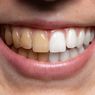 7 Cara Memutihkan Gigi Kuning secara Alami