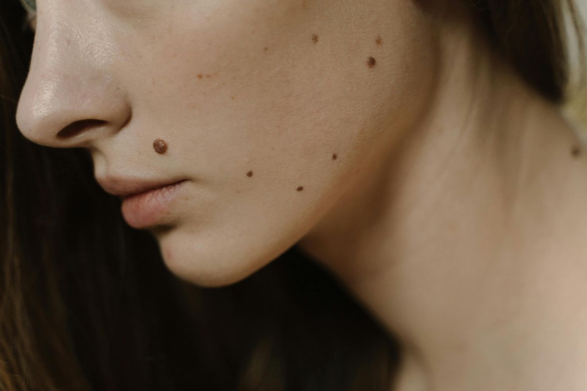 Metode ABCDE bisa digunakan untuk mengenali tahi lalat pada kulit yang menjadi tanda kemungkinan adanya melanoma, jenis kanker kulit yang sangat berbahaya.