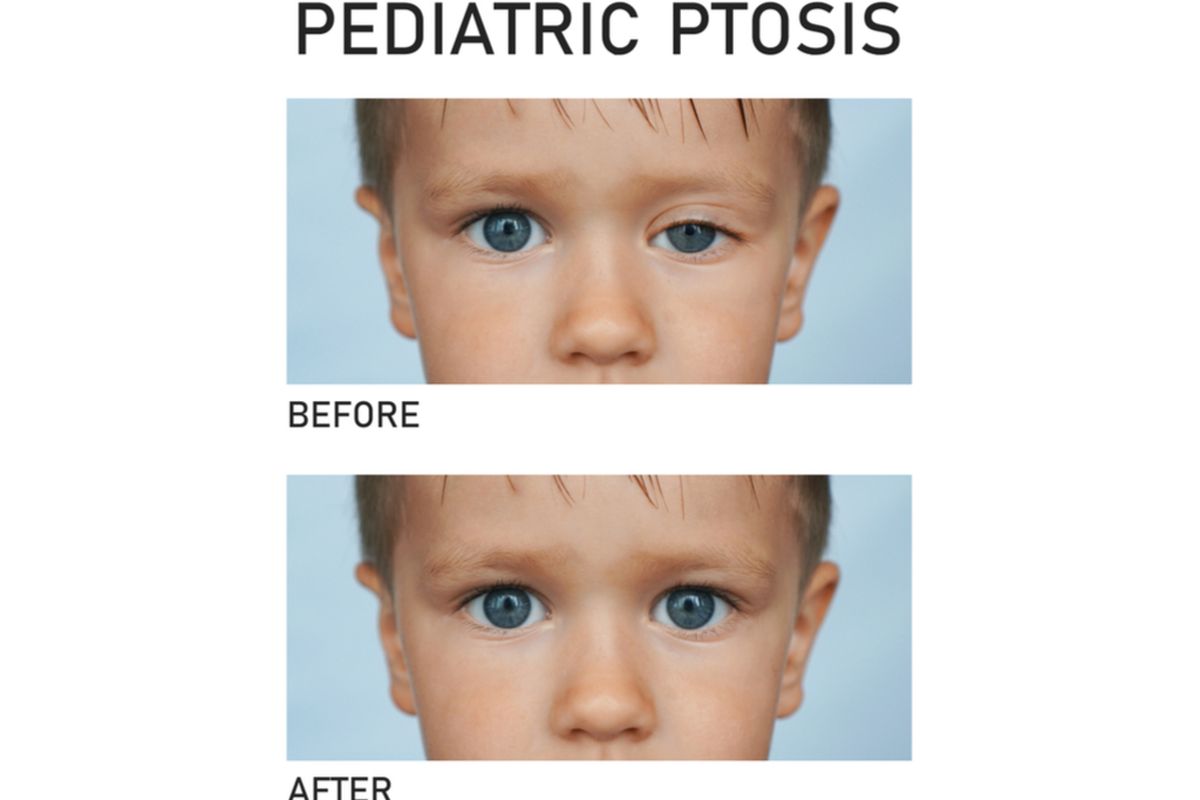 ilustrasi ptosis