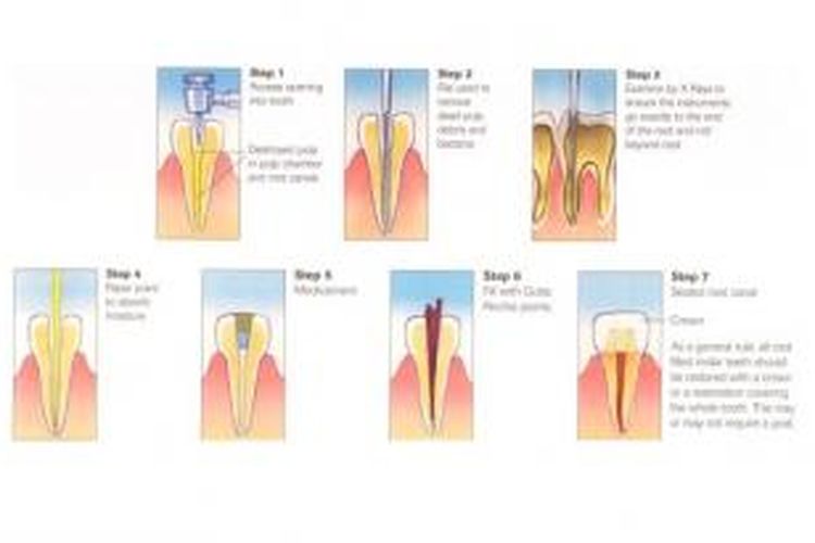 Ilustrasi proses perawatan saluran akar gigi 