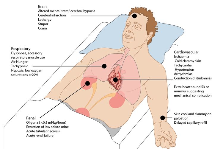 Ilustrasi syok kardiogenik