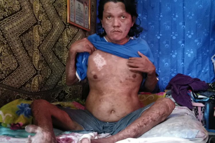 Suhardi (40) warga desa Bambangan Pulau Sebatik Kabupaten Nunukan Kaltara menunjukkan sejumlah bekas luka yang mulai kambuh akibat lepra. Setiap ada benjolan sebesar ujung jari pecah, tubuh Suhardi akan dipenuhi borok dan berulat