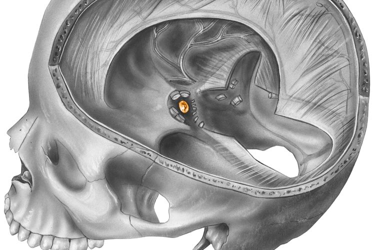 Ilustrasi posisi sella turcica dan kelenjar pituitari, bagian dasar otak yang terkena empty sella syndrome