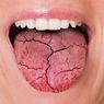 Dokter Unair: Mulut Kering Bisa Pertanda Kena Penyakit Serius Ini