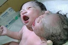 Bayi Berkepala Dua Lahir di Makassar