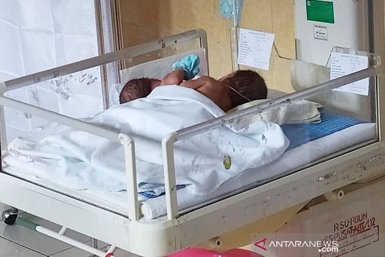 Bayi kembar siam dempet perut dan dada di Kotawaringin Barat, Pangkalan Bun, Kalimantan Tengah